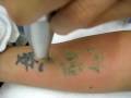 Free Tattoo Removal Houston Tx