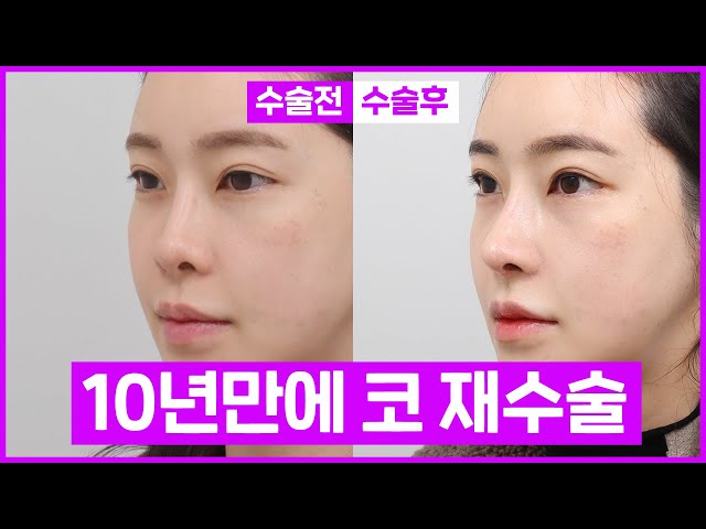 [코재수술 리뷰] L자 실리콘 안 씁니다 | 성형비포애프터 | 에이비성형외과