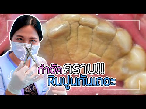 วีดีโอ: วิธีการขุดหินปูน