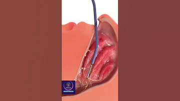 Nasal Turbinate Surgery #shorts