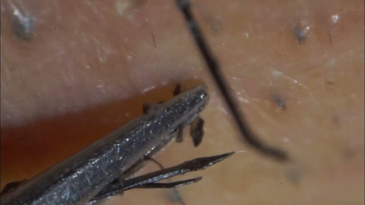 23min Ingrown hair removal Tweezers 4x Zoom UP Satisfying pull out