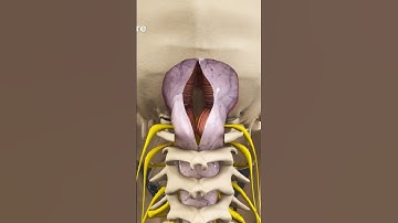Chiari Decompression Surgery