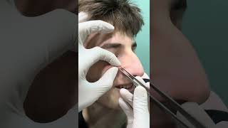 Whiteheads, Blackheds Extractions 🤔