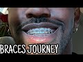 “Embracing the End: The Final Chapter of My Braces Journey”