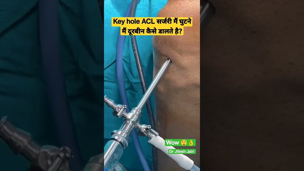 Key hole ACL सर्जरी मैं घुटने मैं दूरबीन कैसे डालते है? Dr Jitesh Jain #shorts #aclsurgery #acl