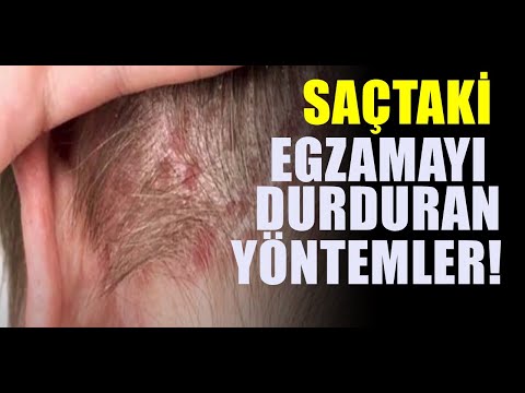 Saç egzaması nasıl geçer? Doğal tedavi yöntemleri nelerdir?