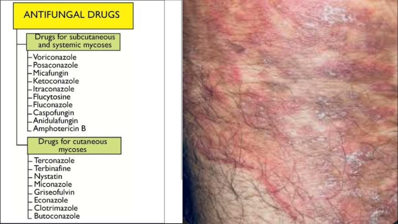what-is-antifungal-drugs-types-of-antifungal-drugs-name