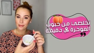 تخلصي نهائيا من حبوب المؤخره و تحصلي علي بشرة ناعمه 🍑