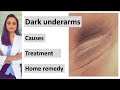 How to get rid of Dark underarms | causes|  treatment| home remedy| Dermatologist | Dr. Aanchal