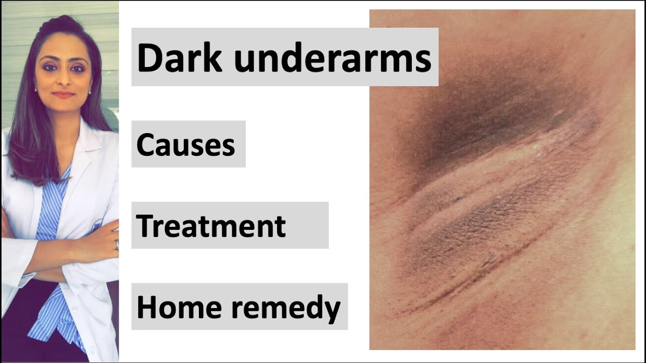 How To Get Rid Of Dark Underarms | Causes|  Treatment| Home Remedy| Dermatologist | Dr. Aanchal