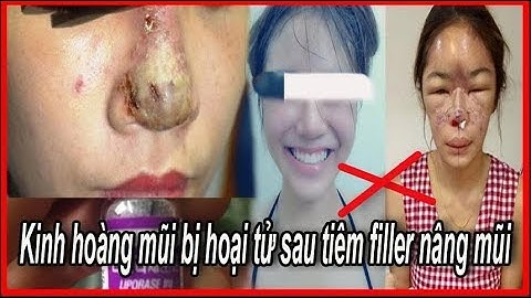 Kinh hoàng mũi bị hoại tử sau tiêm filler nâng mũi