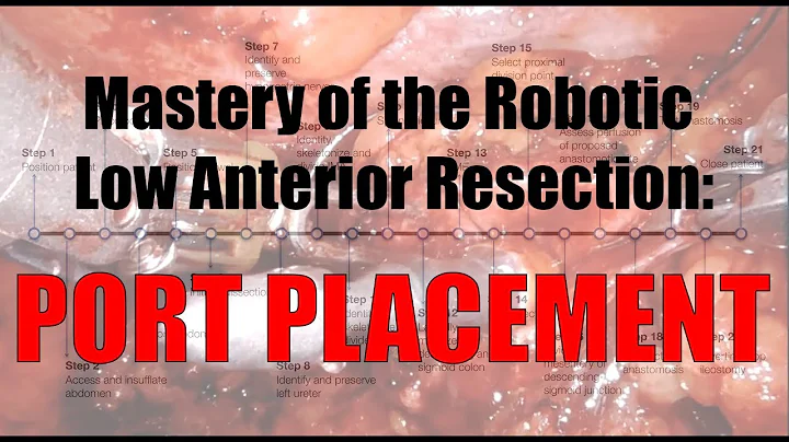 Robotic Low Anterior Resection Port Placement - da...