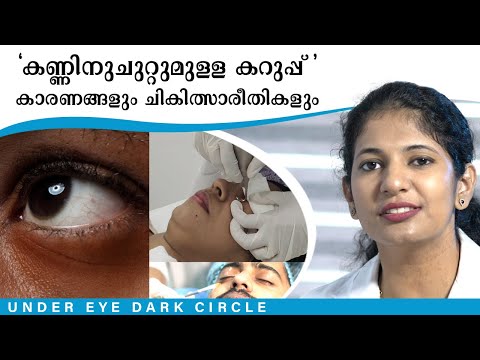 Under eye dark circles- Causes & Treatment 🔥കണ്ണിനു ചുറ്റുമുള്ള കറുത്ത പാടുകൾ -  ചികിത്സാരീതികൾ  🔥 — DermaVue dermatologist explainer