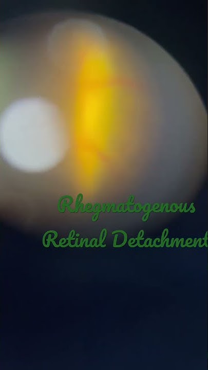Mobile rhegmatogenous Retinal detachment on slit lamp. - YouTube