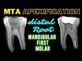 MTA APEXIFICATION | Mandibular First Molar | Apexification Step by Step