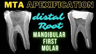 MTA APEXIFICATION | Mandibular First Molar | Apexification Step by Step screenshot 3