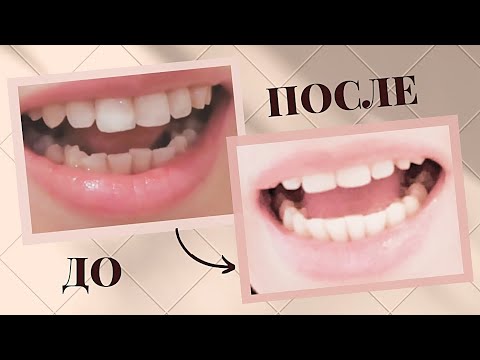 Элайнеры - "ЗА или ПРОТИВ" | Моя история зубов