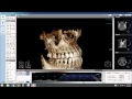 How to Segment the Maxillary Sinus in LED Dental&#39;s Xelis 3D Imaging Software