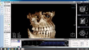How to Segment the Maxillary Sinus in LED Dental
