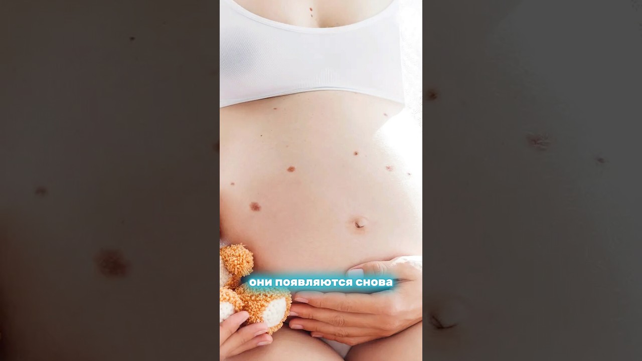 РОДИНКИ при беременности: ОПАСНЫ ли?