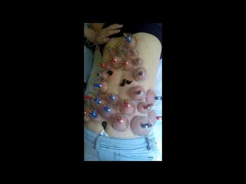Пример постановки пиявок на почки и 1-ю чакру.