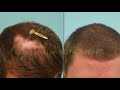 Dallas Hair Transplant for Scarring Alopecia, LPP