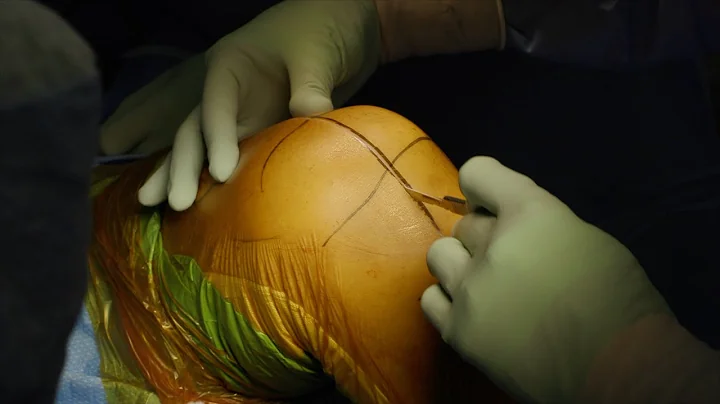 Mako Total Knee Arthroplasty (TKA) Surgical Technique