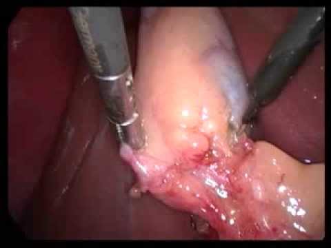 Laparoscopic Cholecystectomy (unedited-59)-Chr Cholecystitis Moderate Omental Adhesion