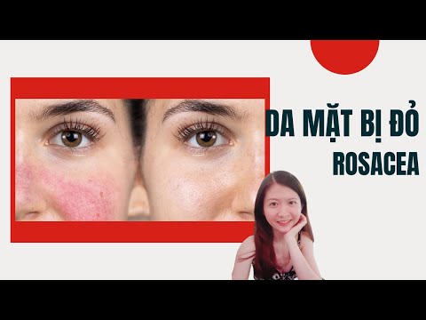 #14.DA MẶT BỊ ĐỎ, DỊ ỨNG , BỆNH ROSACEA, GIÃN MAO MẠCH | MOONSTORY