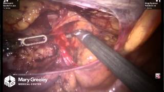 Robot-Assisted Hernia Repair (Full Length Surgery)