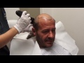 Haartransplantation Willi Herren