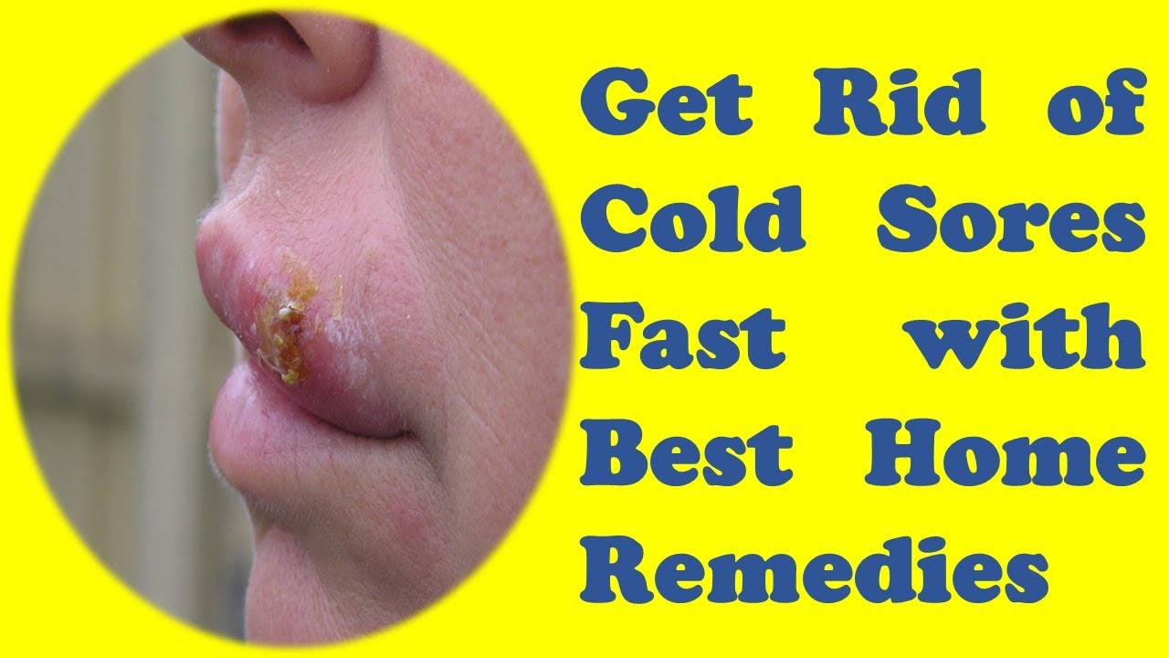 how to get rid of a cold sore