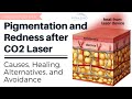 Skin Discoloration after Fractional CO2 Laser for Acne Scars: Risks, Alternatives, and Treatments