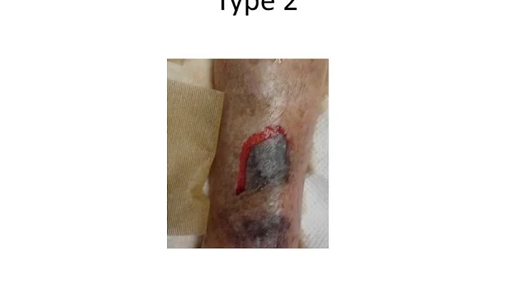 AM2 Advanced Wound Care - Kim LeBlanc