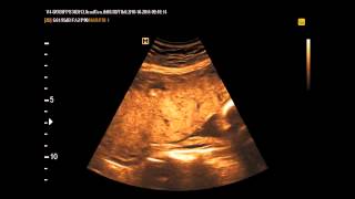 Med2000Eco Placenta Previa Centrale