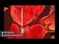 Mitral Valve Repair Surgery - Cardiac Animation