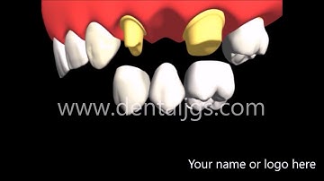 Dental Animation - Conventional Fixed Partial Denture - Clinic Package
