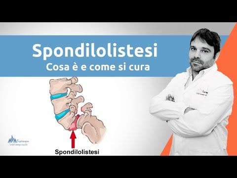 Video: Differenza Tra Spondilosi E Spondilolistesi