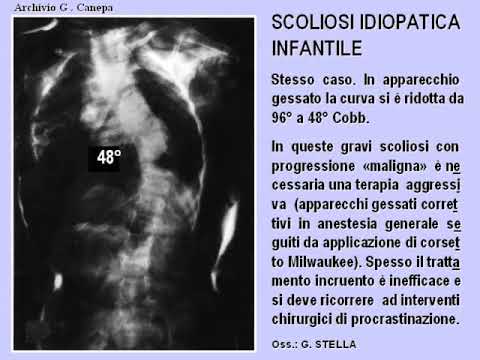 Z39A  31 34 scoliosi idiopatica infantile
