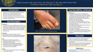 ACP 2020 Presentation  - DRESS with Naproxen