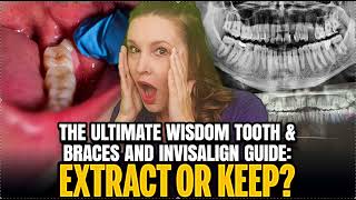 The ULTIMATE Guide to 3rd Molars, Wisdom Teeth with Braces and Invsisalign
