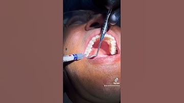 All-on-6 Dental Implant" to restore the smile and function. 📞+971 43533101 for Free Consultation