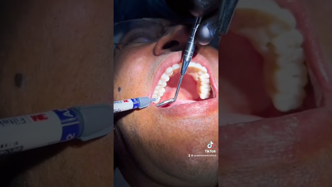 All-on-6 Dental Implant" to restore the smile and function. 📞+971 43533101 for Free Consultation