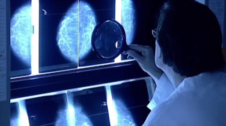 New guidance lowers the recommended age for regular breast cancer screenings