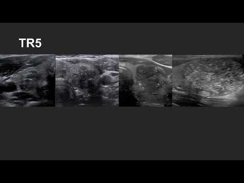 Thyroid nodules and Tirads