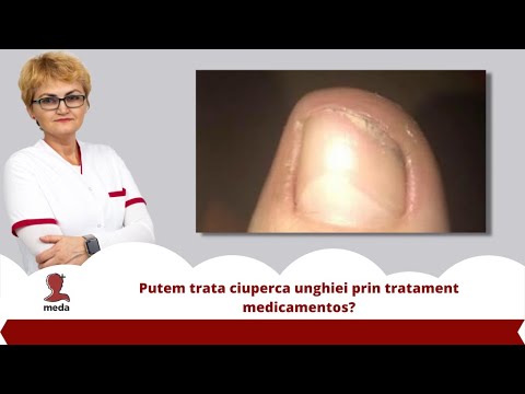 terapia cu urină a ciupercii unghiilor care este ciuperca unghiei de pe mână