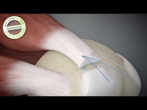 Video: 3 Möglichkeiten, einen Bizepsriss zu beheben