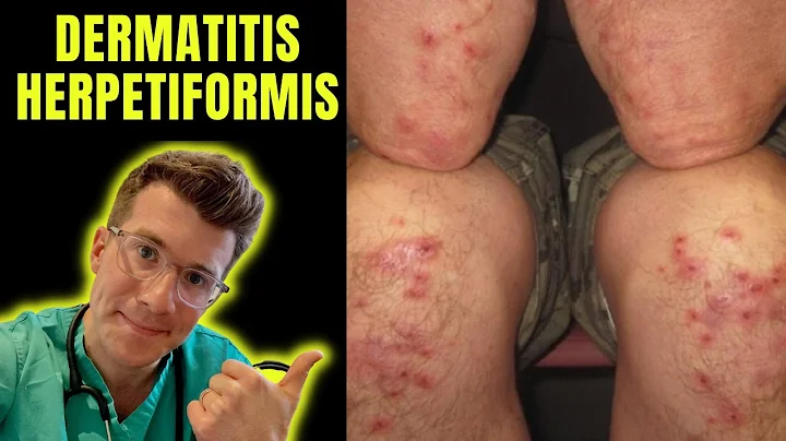 Dermatitis Herpetiformis (rash seen in Coeliac Disease aka gluten intolerance) explained... - DayDayNews