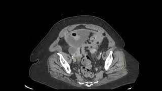 Primary peritoneal carcinomatosis simulating ovarian cancer