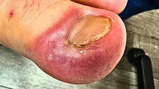 DEEEEEP Extreme Ingrown Nail Removal On Muay Thai Boxer!